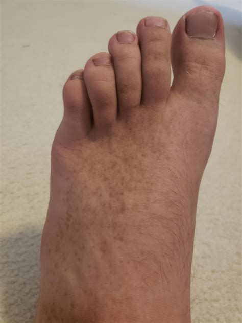 What Are These Brown Spots On My Foot Rmedical