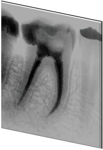 Davini Endodontia e Microscopia Operatória Tratamento endodôntico dente sessão única