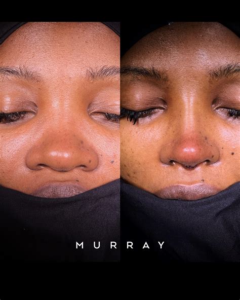 Wide Nose Rhinoplasty Black