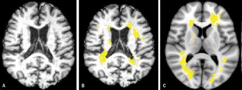 A Linear Registration Of Multiple Sclerosis Plaques And Scans Of Axial