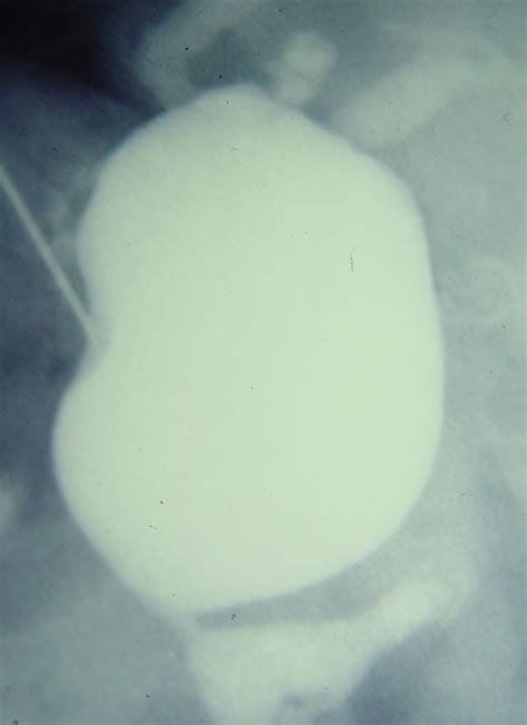 Biliary Choledochal Cyst 1499 Common Duct Choledochal Cyst 1 Surgery