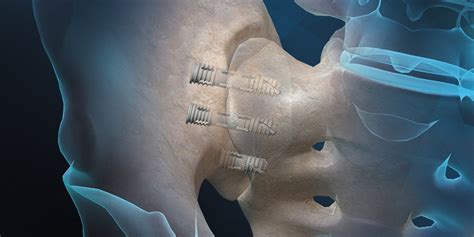 Fda Clears Nano Upgrade For Si Fusion System Orthopedics This Week