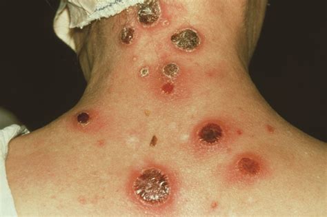 The cause of syphilis is a bacterium called treponema pallidum. Syphilis: diagnosis and management options - The Pharmaceutical Journal