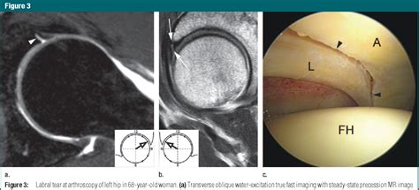 Figure 3 From Mr Arthrography Of The Hip Differentiation Between An