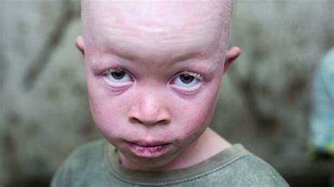In Parts Of Africa People With Albinism Are Hunted For Their Body