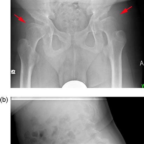 a an anterior posterior pelvic radiograph at 16 years of age showing download scientific
