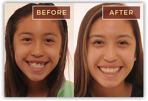 Before After Braces