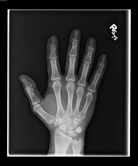 Hemophilic Arthropathy X Rays Case Studies Ctisus Ct Scanning