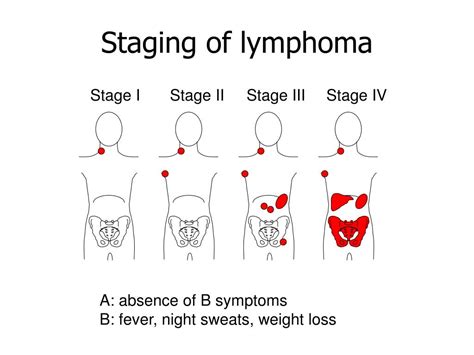 Ppt Lymphoma Powerpoint Presentation Free Download Id384235