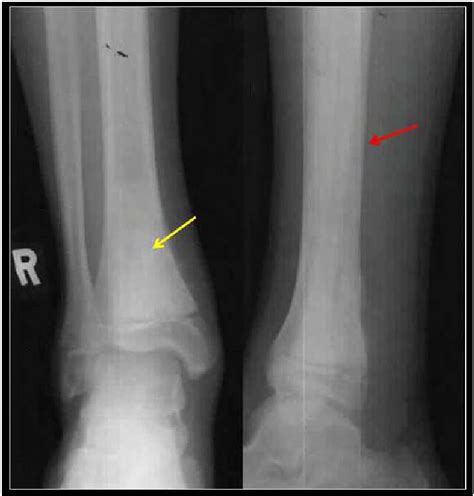 The Illustration Shows A Radiograph Of A Right Ankle In A 12 Year Old