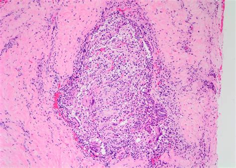 Pathology Outlines Idiopathic Granulomatous Mastitis