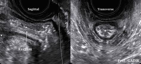 Pin On Gynae Ultrasound