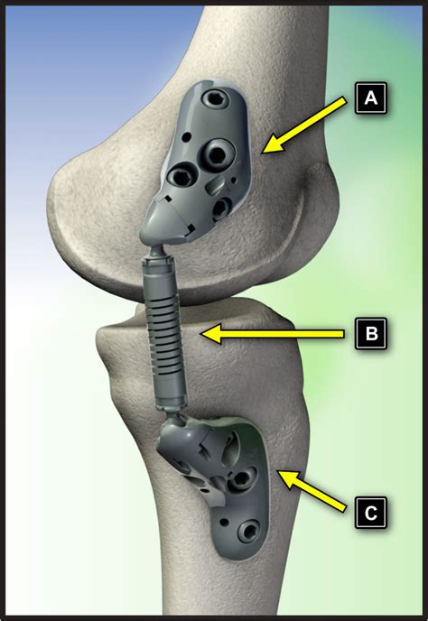 The Kinespring ® Knee Implant System Femoral Base A Absorber Unit