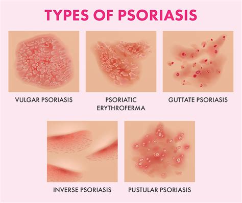 Psoriasis Types Symptoms Causes And Treatment Apollo Sexiezpicz Web Porn