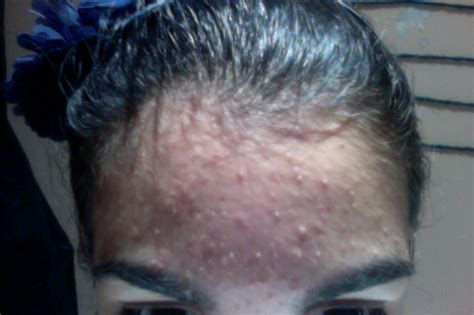 Small Clear Bumps On Forehead General Acne Discussion