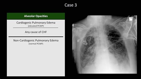 How To Interpret A Chest X Ray Lesson 10 Self Assessment Part 1 Youtube