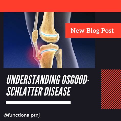 Understanding Osgood Schlatters Disease