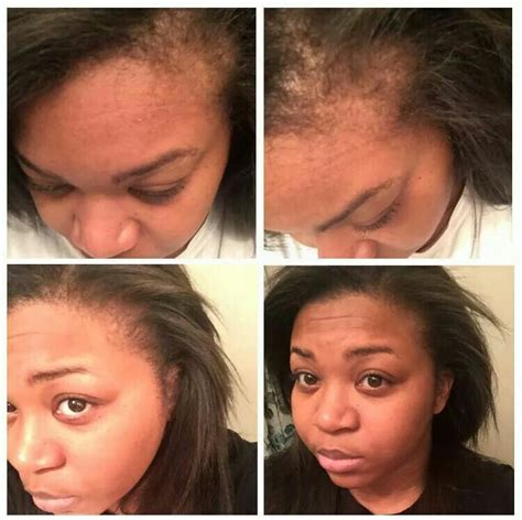 Love Her Results Just After Ywo Weeks Of My Hair Skin Nails