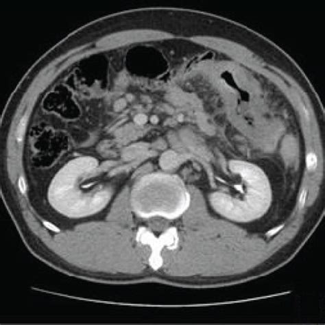 Ct Scan Of Patient No 5 A Axial Section Of The Ct Scan Showed An