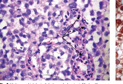 Figure 3 From Eosinophilic Granuloma Of Mandible A Report Of Two
