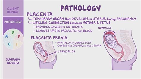 Placenta Previa Nursing Process Adpie Osmosis Video Library