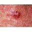 Basal Cell Carcinoma On A 78 Year Old Mans Skin Photograph By Dr P 