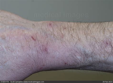 Stock Image Infected Cat Bite On The Wrist Of A 60 Year Old Man
