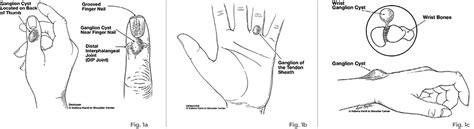 What Are Ganglion Cysts Patient Education Ihtsc