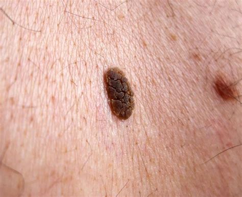 Seborrheic Keratosis Symptoms Causes Diagnosis And Treatment