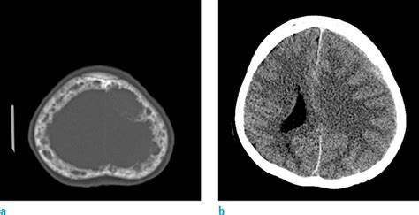 A Rare Case Of Diffuse Pachymeningeal Involvement Of Multiple Myeloma