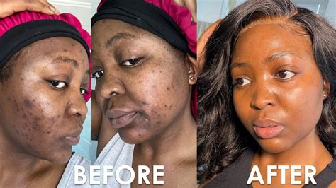 How I Cleared My Acne Acne Journey Youtube