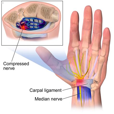 Median Nerve What Is It Symptoms And Treatment Top Doctors