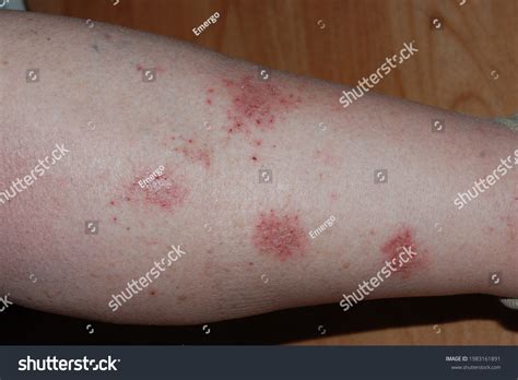 Стоковая фотография 1983161891 Nummular Eczema On Leg Nummular