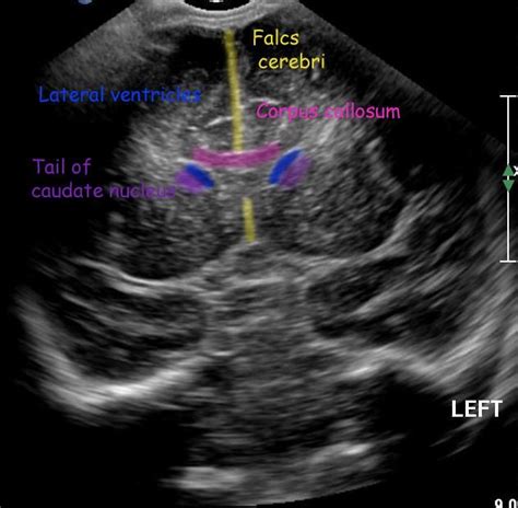 Normal Neonatal Head Ultrasound Medical Ultrasound Ultrasound