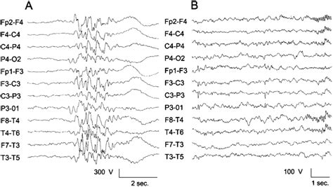 Interictal Eeg Recordings From The Index Patient A Irregular