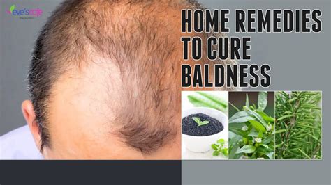 How To Treat Baldness Or Regrow Hair On Bald Spot Home Remedy Man