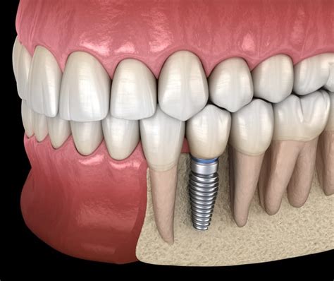 Single Dental Implants Succasunna Nj Tooth Implant
