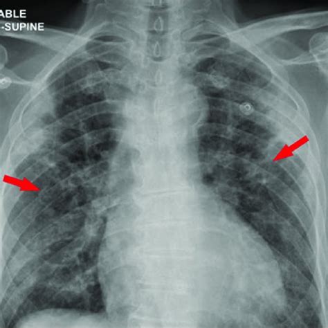 Chest X Ray Red Arrows Point To Bilateral Patchy Infiltrates