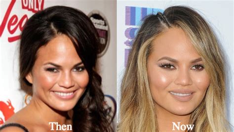 chrissy teigen plastic surgery before and after photos