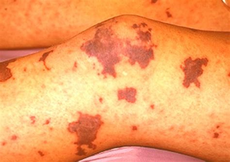 Meningitis Symptoms Treatment Causes Rash Pictures Hubpages