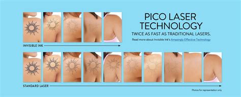 We did not find results for: Tattoo Removal: Innovative Laser Tattoo Removal ...