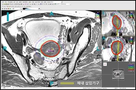 자궁경부암 종양 부위 근접방사선 치료기술 개발