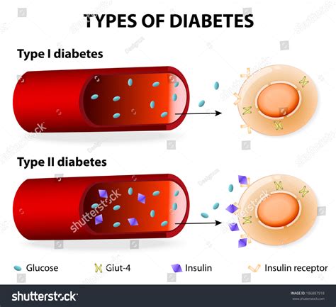 Diabetes mellitus is a chronic condition associated with abnormally high levels of sugar (glucose) in the blood. Types Diabetes Type 1 Type 2 Stock Vector 186887918 ...