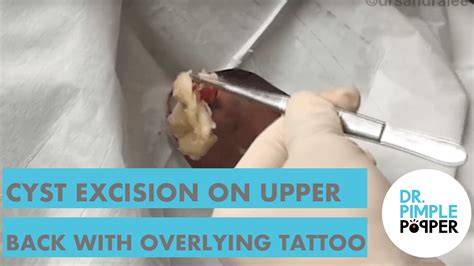 Tbt Cyst Excision On Upper Back Oozy Offerings Dr Pimple Popper