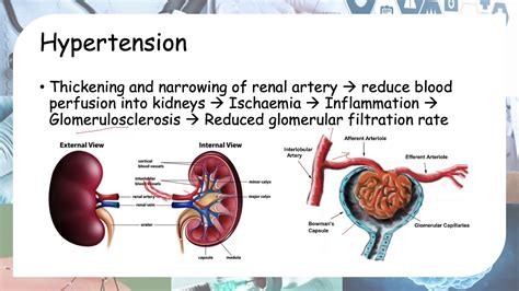 How Diabetes And Hypertension Leads To Kidney Failure Youtube