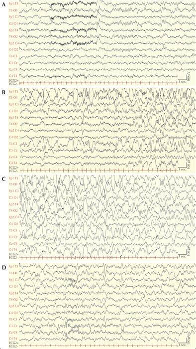 John Libbey Eurotext Epileptic Disorders Bathing Epilepsy A Video