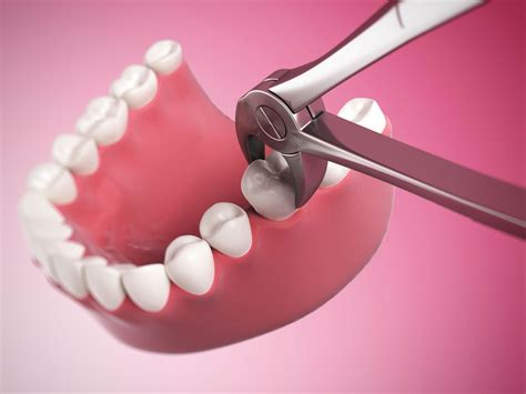 3 Approaches To Placing Implants After Tooth Extractions Chicago