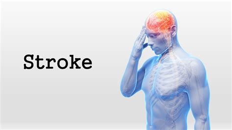 Ischemic stroke (part of the brain loses blood flow); Stroke - YouTube