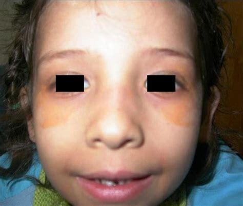 Yellow Deposits Below Eyelids Xanthelasma Pediatric Oncall Journal