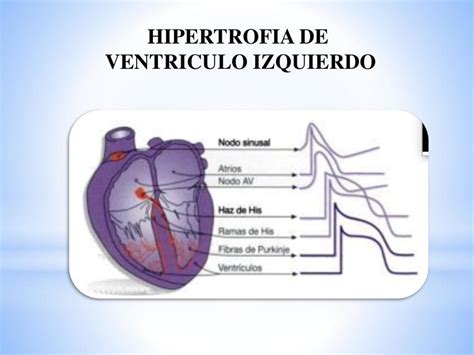 Hipertrofia Ventricular Iz Y Der Electrocardiograma